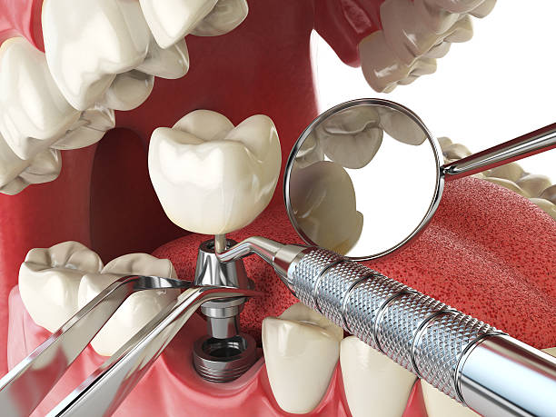 Best Emergency Tooth Extraction in Aberdeen, WA